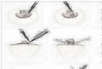 发现乳头内陷怎么办 合肥华美徐海燕主任教你怎么办