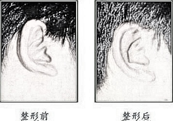 兰州美丽达整形医院杯状耳矫正有哪些优点 轻松拥有耳朵