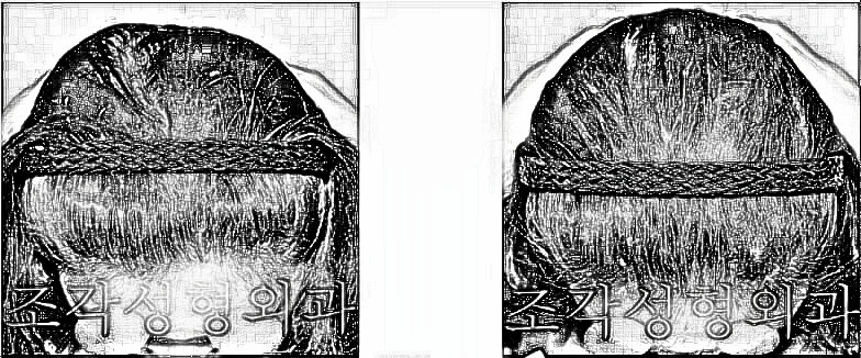 3名额头整形介绍：骨水泥填充头部塑造头型