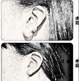 湘潭耳部整形 湘潭雅美整形医院耳垂再造需要多少钱