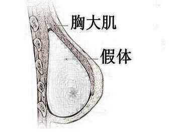 北京艺美整形医院地址 乳房再造需要多少钱