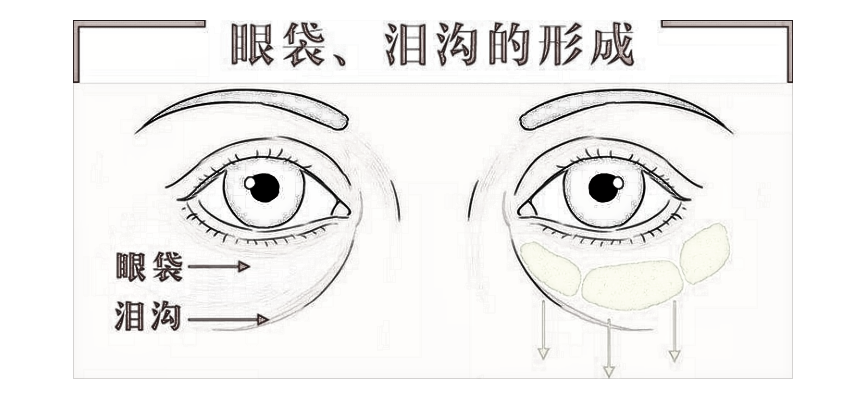 去眼袋和黑眼圈一步到位，这个方法可行!