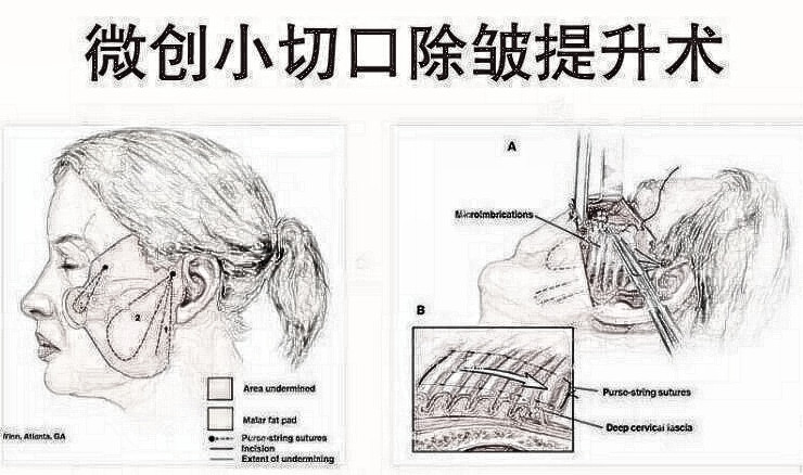 拉皮的副作用大吗？都是“危言耸听”！