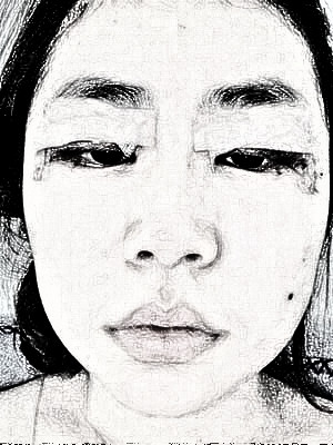 心心念念三年后,我终于做了双眼皮手术,果