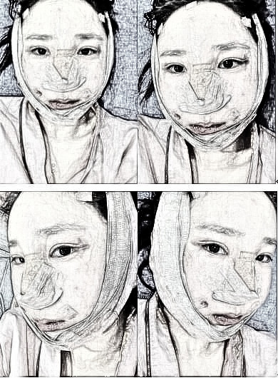 全脸只有眼睛好看,脸型和鼻子做了大改造