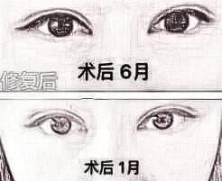 双眼皮失败介绍大全：深度解析失败原因