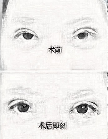 双眼皮失败介绍大全：深度解析失败原因