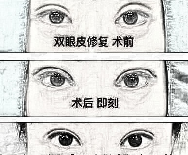 双眼皮失败介绍大全：深度解析失败原因
