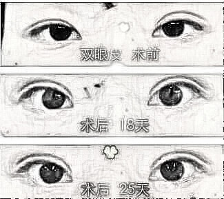 双眼皮失败介绍大全：深度解析失败原因