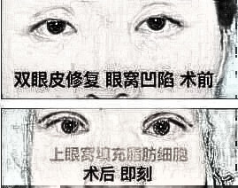 双眼皮失败介绍大全：深度解析失败原因