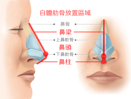 这3种自体软骨移植隆鼻术，肋骨、耳软骨、鼻中隔如何选