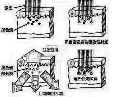 黄褐斑怎么消除？有办法吗？听说黄褐斑很难除掉