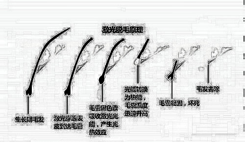 络腮胡子怎么去除？可以做激光脱毛手术吗？