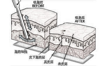 环形抽脂有什么危害吗？告别“五花肉”还是抽脂好