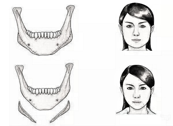 两年前做了下颌角截骨手术，如今来给大家科普一下！