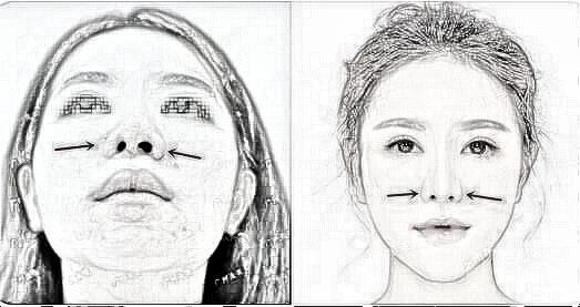 罗延平隆鼻子介绍有吗？做得好吗？憋着急，这就给你看一个！