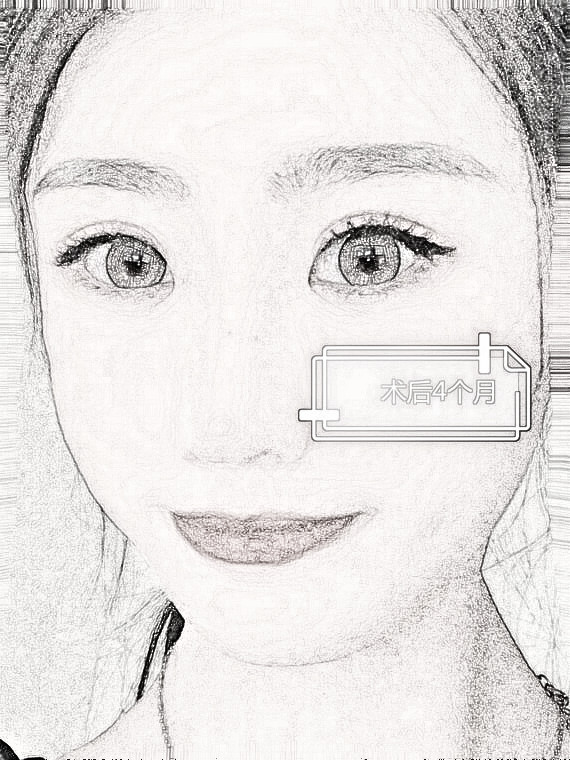 双眼皮手术近视也可以做吗？