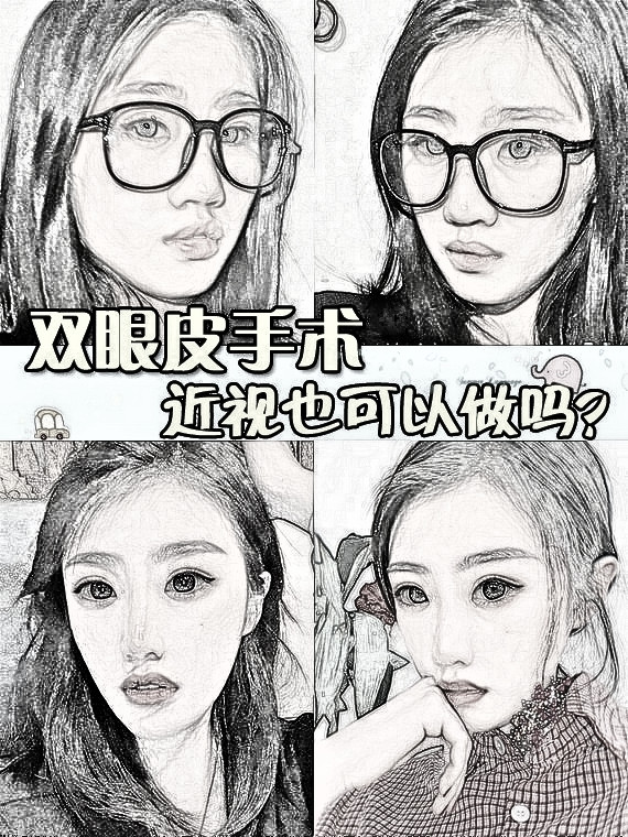 双眼皮手术近视也可以做吗？