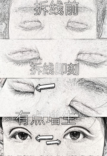 上海九院程辰医生全切双眼皮+开内眼角介绍分享