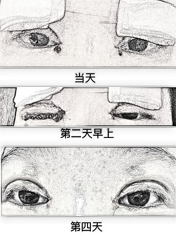 湖南省湘雅附一龙剑虹做的双眼皮和开眼角心得体会