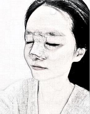 深圳蒳美迩朱灿博士做的鼻部手术手术