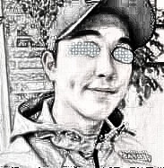 男性也可做隆鼻~男性介绍手术欣赏
