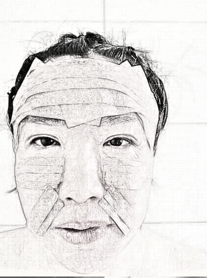 纳米脂肪填充面部后的果令人惊讶，来看