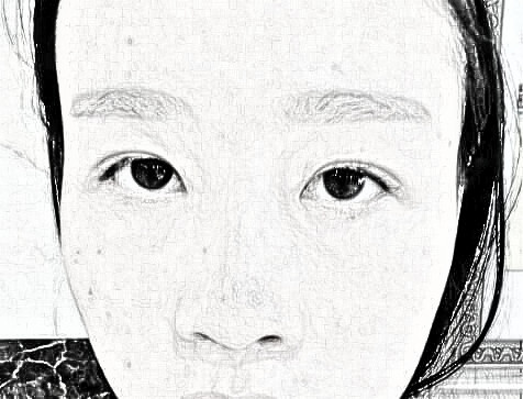 去九院做了眼袋去除手术~来看看果