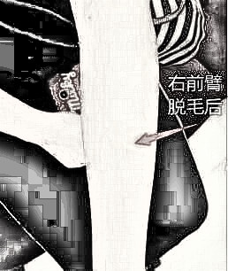 手臂脱毛值得信赖吗?手臂脱毛