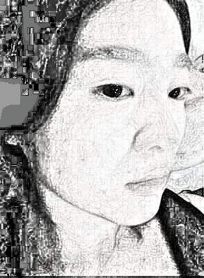 自体脂肪全脸填充术整形介绍分享