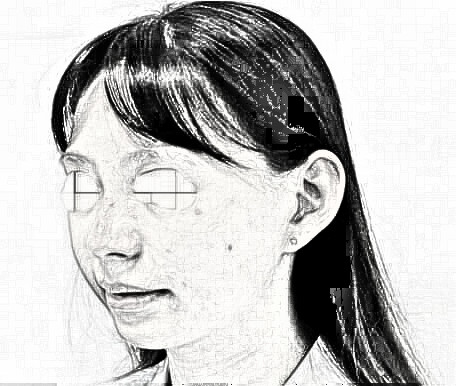全脸自体脂肪填充 觉得真的年轻漂亮了很多