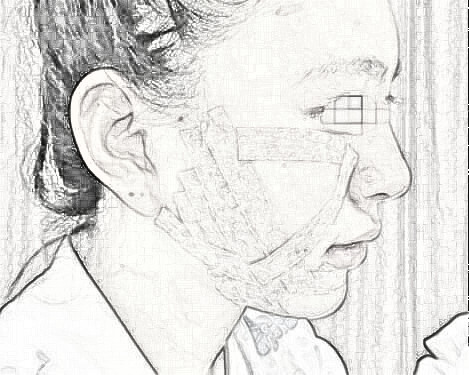 全脸自体脂肪填充 觉得真的年轻漂亮了很多