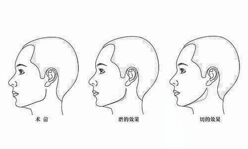 术前了解一下：磨腮削骨需要多少手术费？