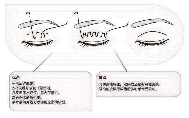 埋线双眼皮是选择松一点？还是紧一点？