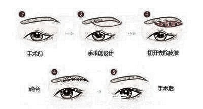做了上睑下垂矫正术多久能恢复