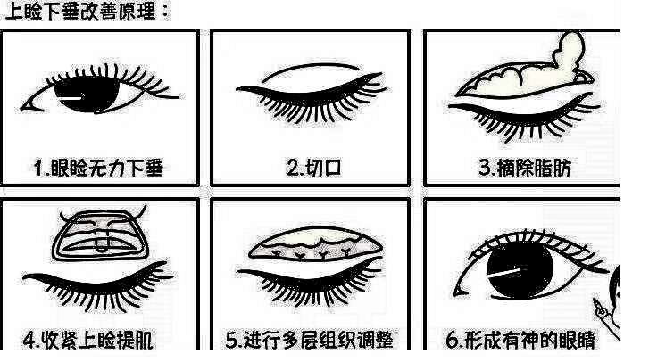 做了上睑下垂矫正术多久能恢复