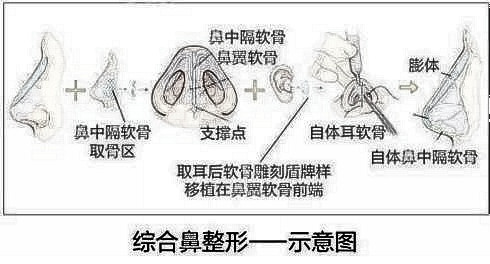鼻部手术一般有多久的恢复期