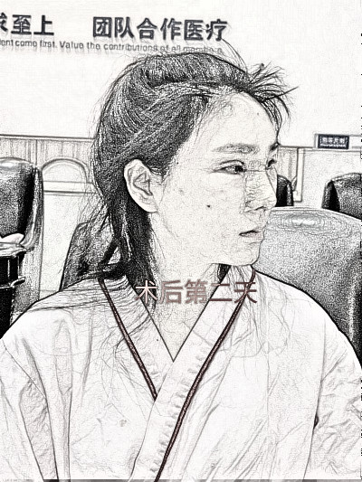 上海百d丽医美医生沈国雄肋软骨隆鼻介绍分享