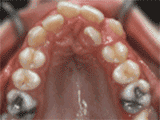 牙齿矫正一定要拔牙——什么情况下？