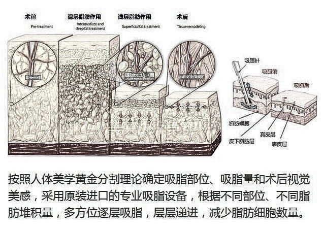 水动力吸脂手术有什么优势?