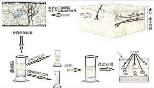 涨知识：自体脂肪移植可用于哪些部位的微整形?