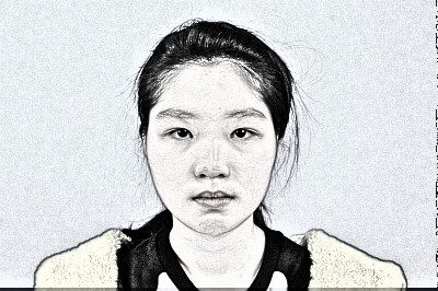 长沙妹纸在美莱医美隆鼻之后恢复感受分享