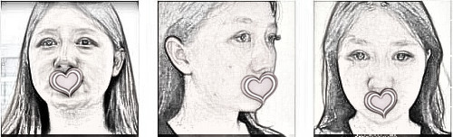 北京炫美医学美容面部吸脂术后68天分享!