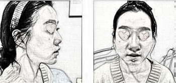 北京炫美医疗美容医生徐学东鼻部手术介绍分享!