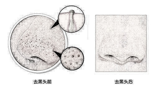 想要去黑头就是这么简单