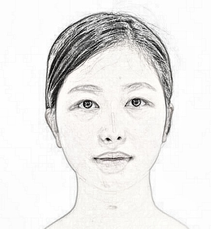 北京妹纸隆鼻+鼻小柱延长整形，分享下过程~