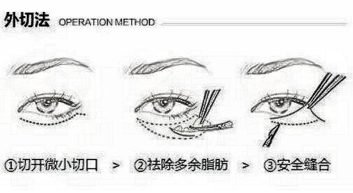 激光和内切祛眼袋哪个更持久?