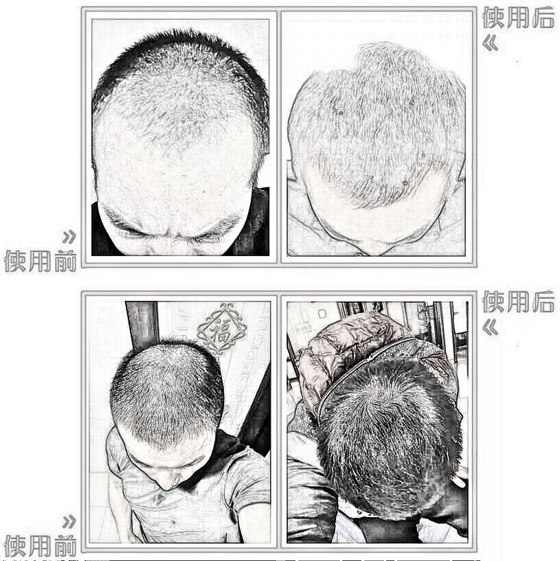 FUT植发猛料——脱发患者的救星
