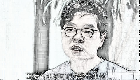 全耳再造手术后需要多久的恢复时间？