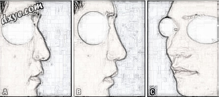 深部scarpa筋膜在隆鼻术中的应用—